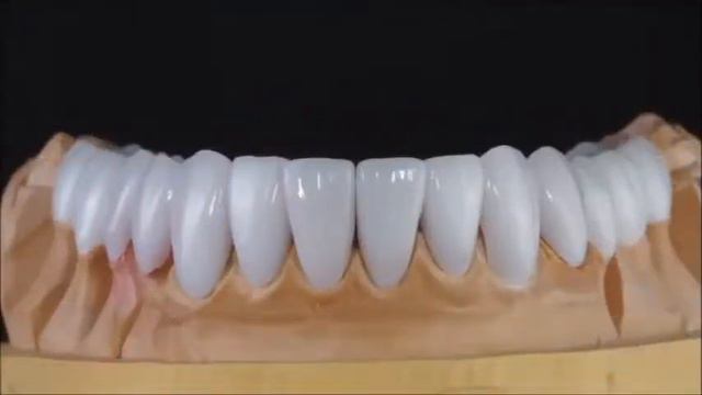 Faţetele (venirele).Керамические виниры смотреть онлайн