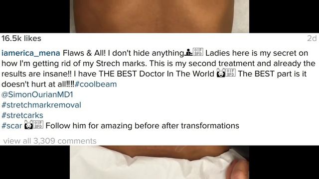 #MILF #EricaMena removes her stretch marks with a laser on video! #LHHNY star! смотреть онлайн