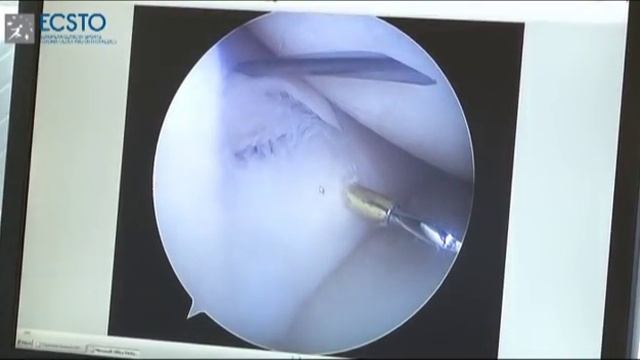 Андрей Королев об операции по сшиванию мениска смотреть онлайн