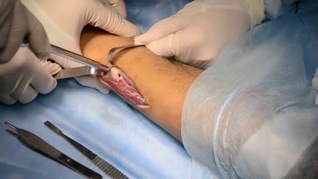 Удаление пластины (локтевая кость) смотреть онлайн