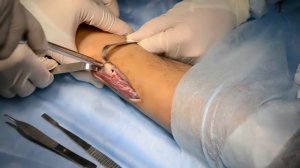 Удаление пластины (локтевая кость)