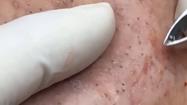 КАМЕДОН\Черные угри\Черные точки\УГРИ\ЧЕРНОГОЛОВЫЕ\прыщи\жировики