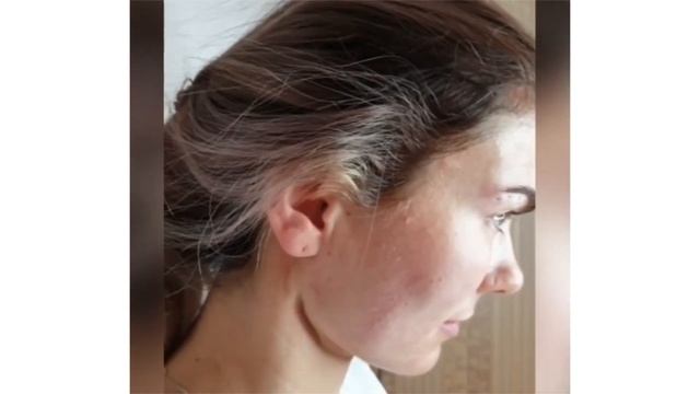 Нитевой лифтинг и его примеры смотреть онлайн