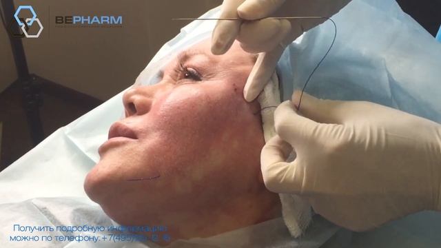 Коррекция брылей С-образными нитями из PDO смотреть онлайн