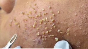 Удаление черных точек 2023 EP04