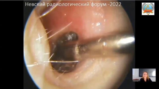 ИННОВАЦИОННЫЕ МЕТОДЫ ЛУЧЕВОЙ ДИАГНОСТИКИ ПАТОЛОГИИ ГОЛОВЫ И ШЕИ ПАЦИЕНТОВ ДЕТСКОГО ВОЗРАСТА смотреть онлайн