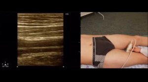 Технология выполнения УЗИ артерий нижних конечностей