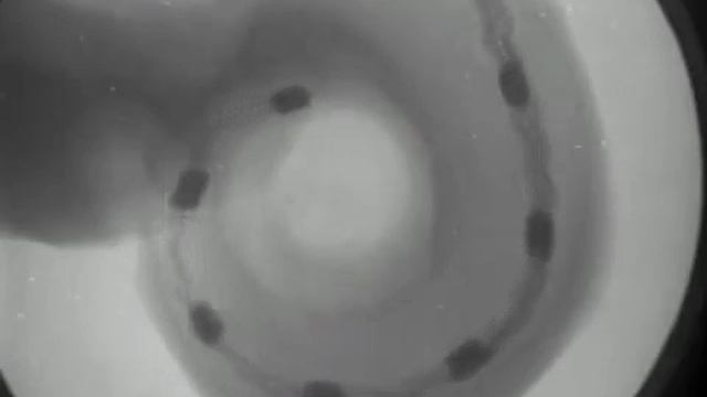 Установка импланта в ухо смотреть онлайн