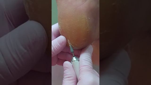 Аппаратный педикюр. Обратотка трещин.