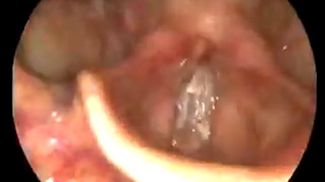 Surgery Video,Laparoscopy,Hysteroscopy,Gastroscopy,Endoscopy,IVF,USG,Colposcopy,ENT,Urologist