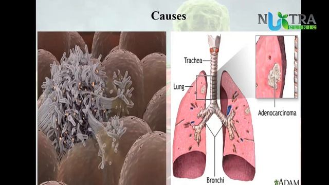 Cancer of Upper GIT Track смотреть онлайн