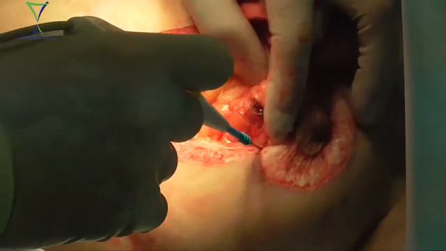 Пластика молочной железы. Greenland Medical RFS 4000K смотреть онлайн