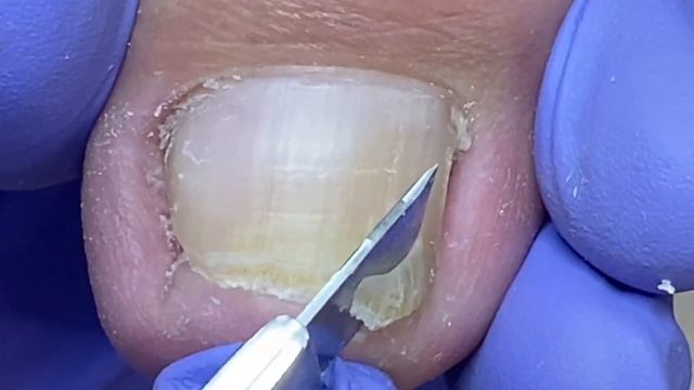 Large Patches Of Ingrown Nails Are Difficult To Handle, Professional Pedicure【Doctor Liu Pedicure】