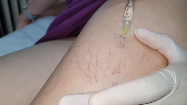 склеротерапия склеротерапия противопоказания как убрать пятна после склеротерапии синяки после цена смотреть онлайн