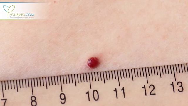 Гранулема – причины, симптомы, осложнения и что с этим делать смотреть онлайн