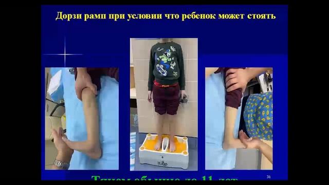 Ортопедическое лечение детей с неврогенными деформациями стоп. Вавилов Максим Александрович. смотреть онлайн