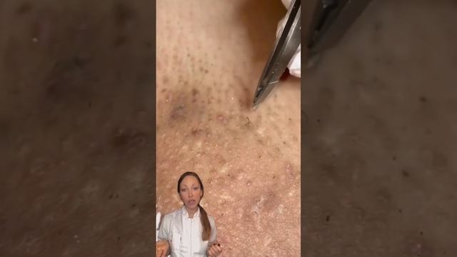 Вросшие волосы ? Как убрать смотреть онлайн