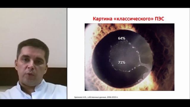 «Современный взгляд на проблему псевдоэксфолиативной глаукомы» смотреть онлайн