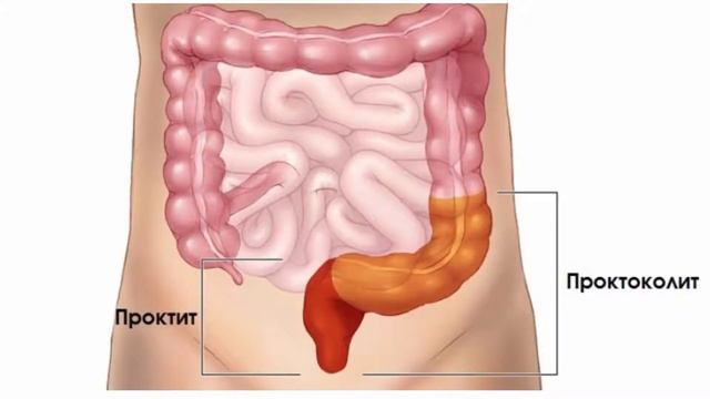 Düz bağırsaq xəstəlikləri | babasil-mualicesi.az смотреть онлайн