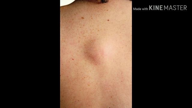 как избавиться от жировика