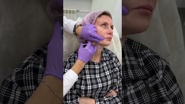 BioHyalux Mevita C - Азиатский протокол введения BV5 смотреть онлайн