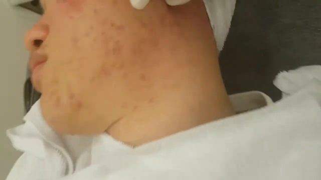 MEDISHINE-ACNE Direct Injection смотреть онлайн