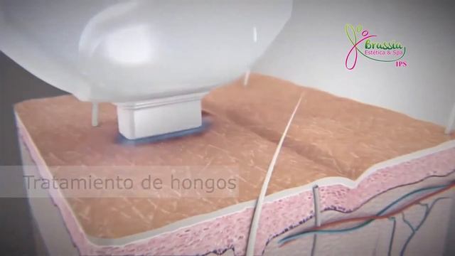 LÁSER HARMONY XL PRO смотреть онлайн