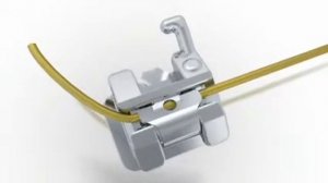 Брекет-замок QUICK на моляры