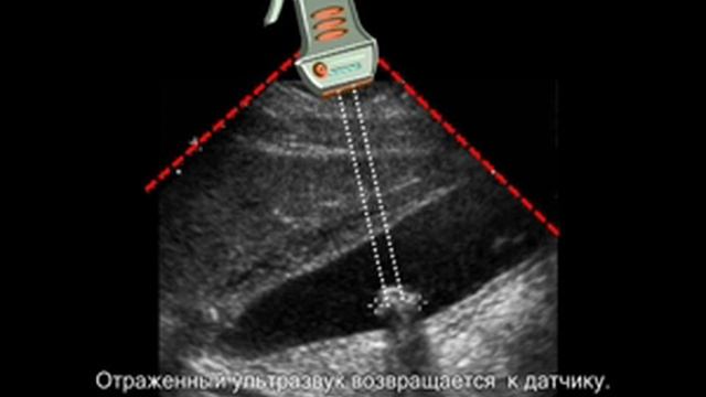 Камень в желчном пузыре на УЗИ смотреть онлайн