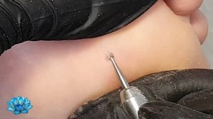 Стержневая мозоль удаление аппаратом.