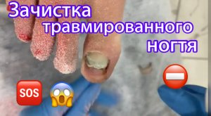 Травмированный ноготь ⚠️?❗️??