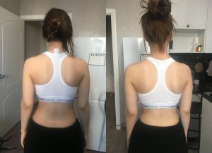 Прощай, сколиоз!