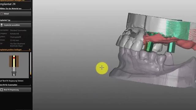 Vorschau Zirkonzahn exocad Abutments смотреть онлайн