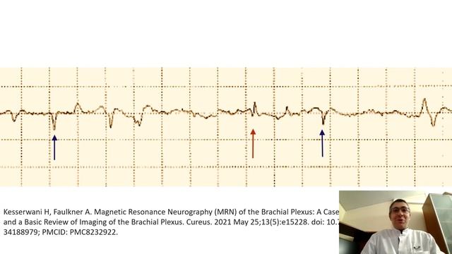 Синдром Персонейджа-Тернера смотреть онлайн