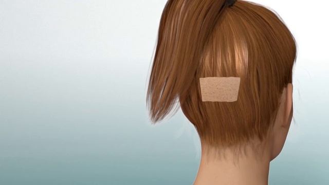 Пересадка бровей методом FUE в Ruben Hair смотреть онлайн