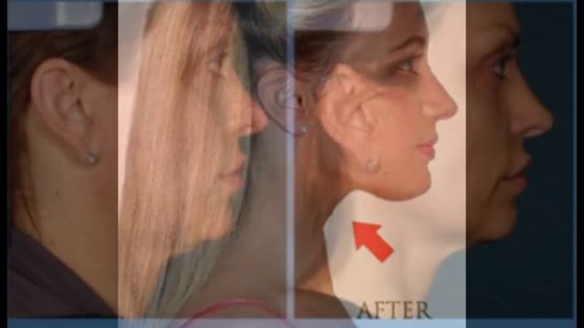 Neckline Slimmer Тренажер для шеи и подбородка !!! смотреть онлайн