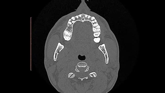 Компьютерная томография лор органов смотреть онлайн