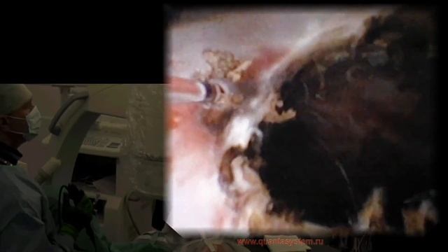 Эндоскопическая марсупиализация парапельвикальной кисты почки смотреть онлайн