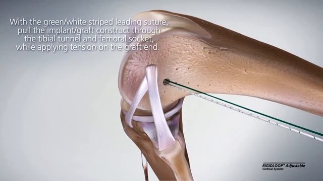 RIGIDLOOP Adjustable Cortical System - Surgical Technique Video смотреть онлайн