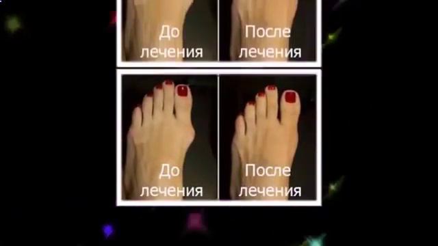 косточка на пальце ноги что делать смотреть онлайн