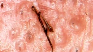 УДАЛЕНИЕ ВРОСШИХ ВОЛОС-ЧЕРВЕЙ ПИНЦЕТОМ!!!