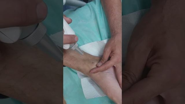 Второй сеанс. Удаление партаков смотреть онлайн