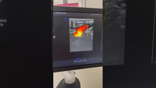 Клапан венозный в паху не состоятелен. Планируем операцию по удалению варикоза. Флеболог Москва смотреть онлайн