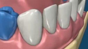 Ортодонтия  Брекеты  Выравнивание зубов