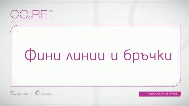 CO2RE - фракционен СО2 лазер за третиране на белези, бръчки и фини линии смотреть онлайн