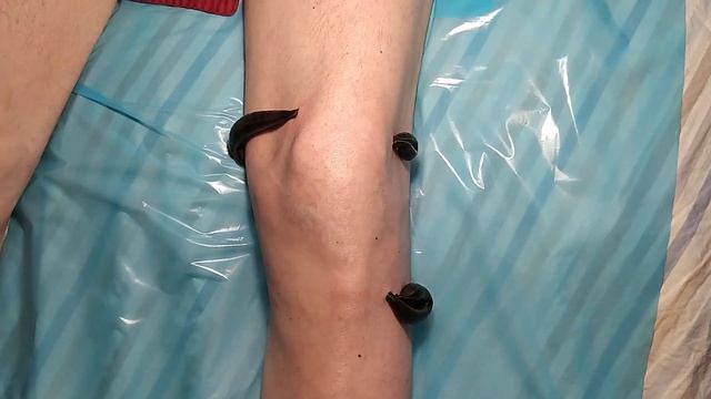 Гирудотерапия после перелома костей голени смотреть онлайн