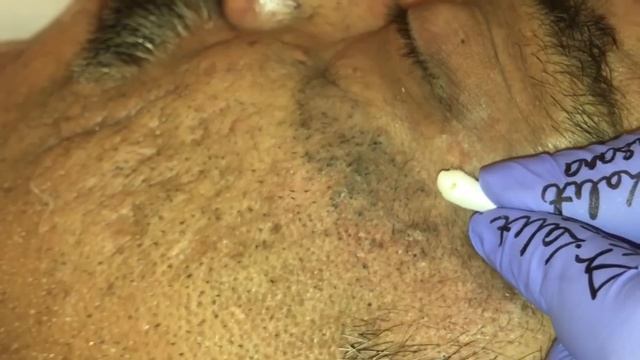 OLD BLACKHEAD REMOVAL WITH COTTON BUDS v s EXTRACTORS PART 2 by DR LALIT KASANA смотреть онлайн