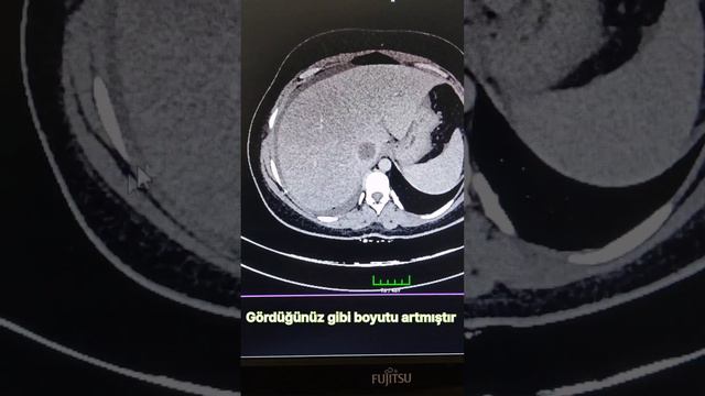 Синдром Бад Киари #радиологиявтурции #лечениевтурции #Кыргызстан #тромбозсосудов #клиникитурции смотреть онлайн