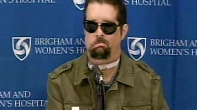 Даллас Винс .Первый пациент в соединенных штатах, которому была сделана полная пересадка лица.