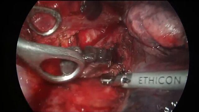 MI Ivor Lewis Esophagectomy with Radical Intrathoracic Lymph Node Dissection - Thoracic Part смотреть онлайн